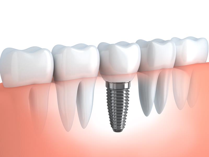 Dental Implants  Flint, MI 