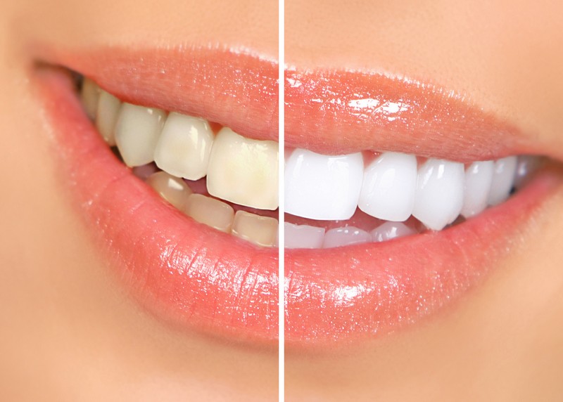 Teeth Whitening Flint, MI