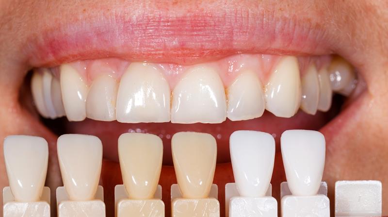 Veneers  Flint, MI 
